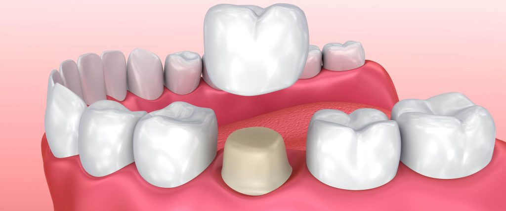 https://smileteamturkey.com/wp-content/uploads/2019/06/dental-crowns-1024x427.jpg