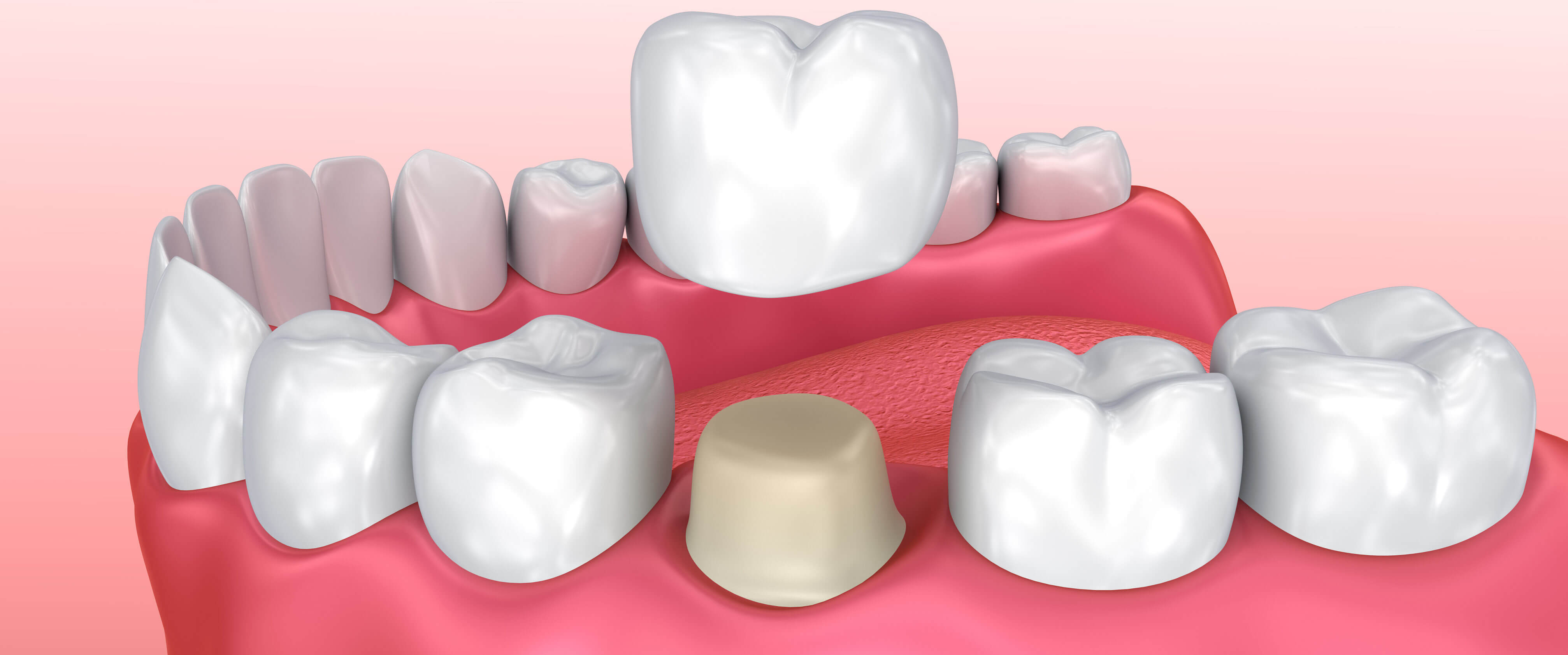 Dental Crowns Turkey | Porcelain, Zirconia & E-max Cost