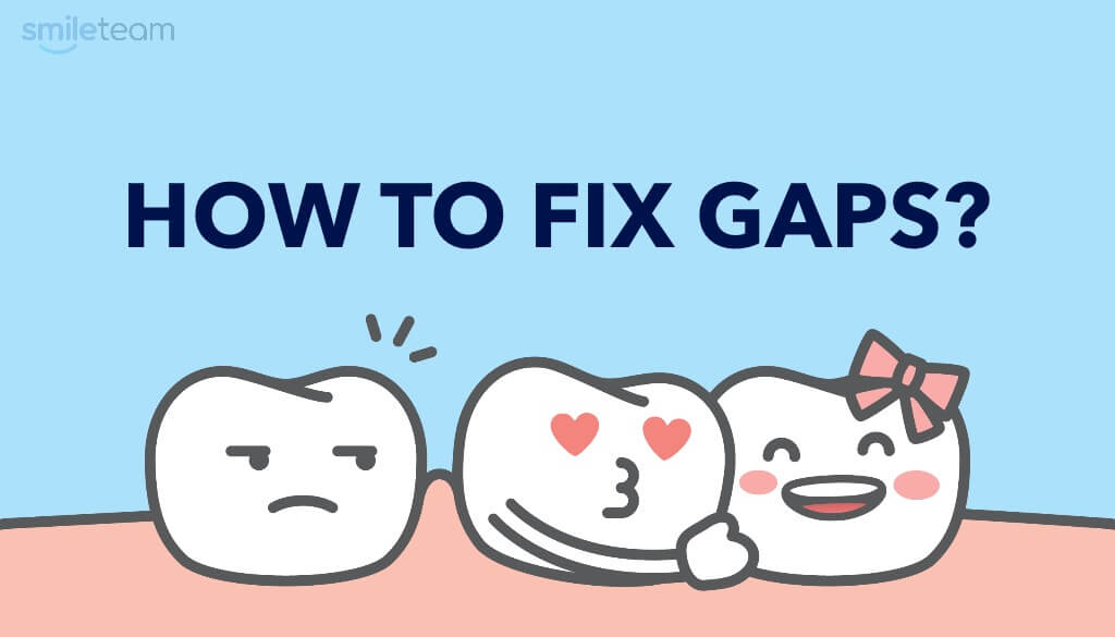 How to Fix Gaps between Teeth