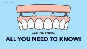 All-on-4 Dental Implants