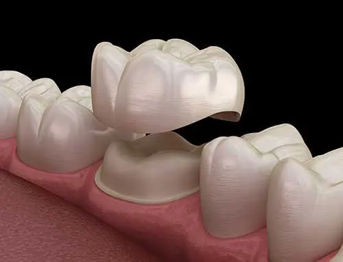 Dental Crown 2