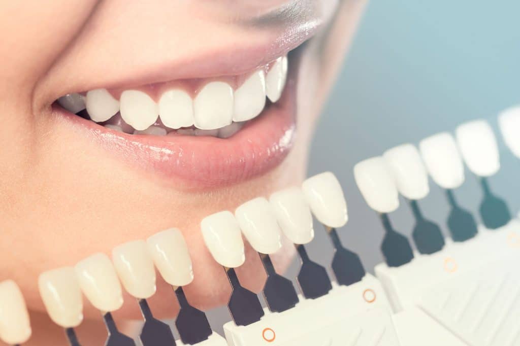 Dental Veneers: Guide, 2-Step Procedure And Cost In Turkey