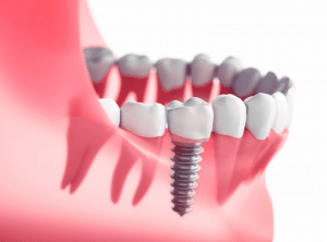 Common dental implant problems