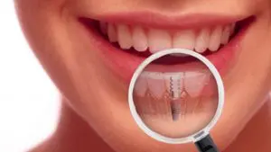 Dental Implant Problems