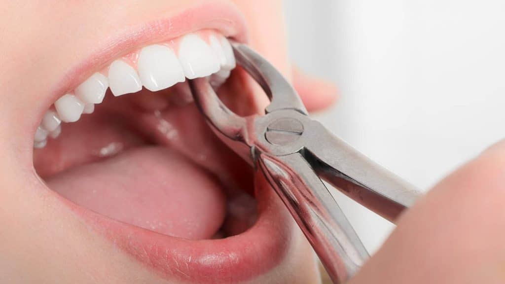 tooth extraction