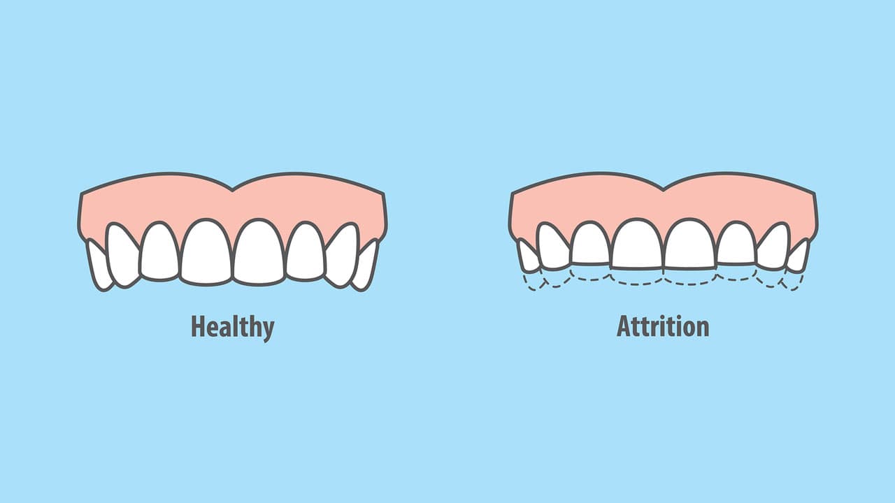 Clenching And Grinding Teeth Handling These Nasty Habits