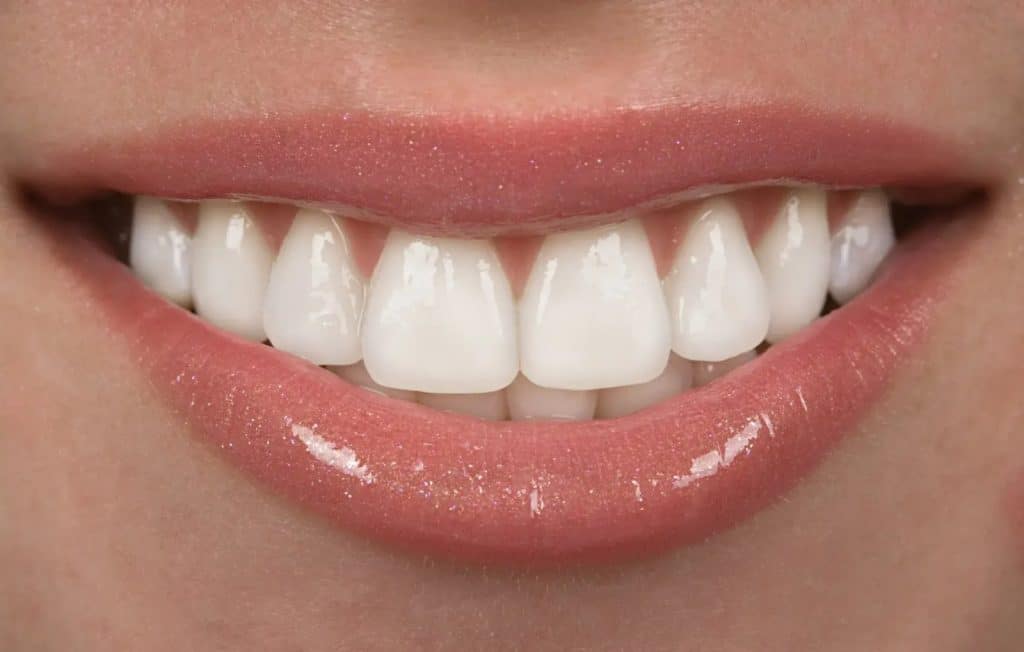 how long do veneers last