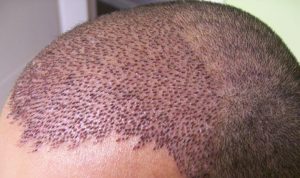 HAIR TRANSPLANT IN TURKEY