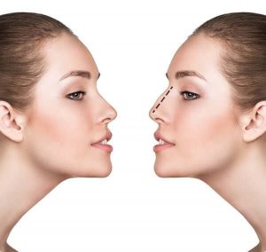 RHINOPLASTY IN TURKEY