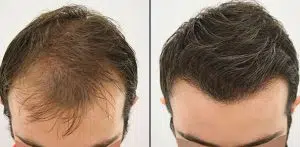 Why is Turkey number one in hair transplantation?