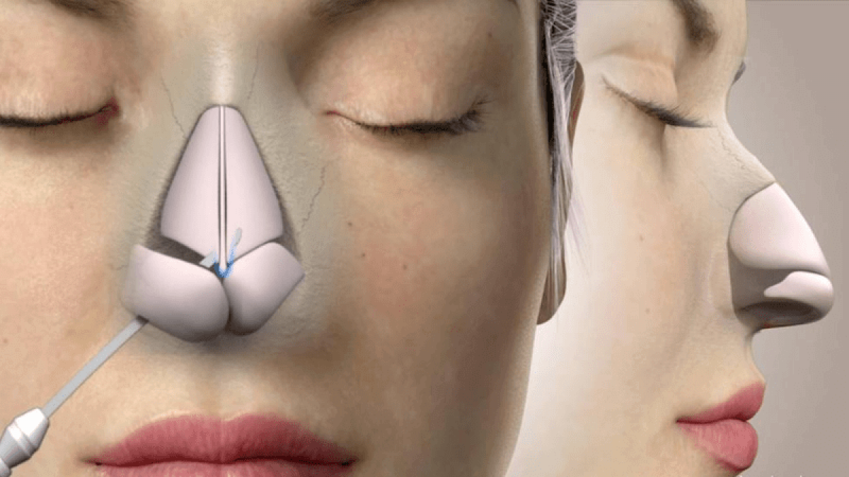 健康・医学 Closed rhinoplasty Closed Rhinoplasty Or Open Rhinoplasty? - Smile Team Turkey