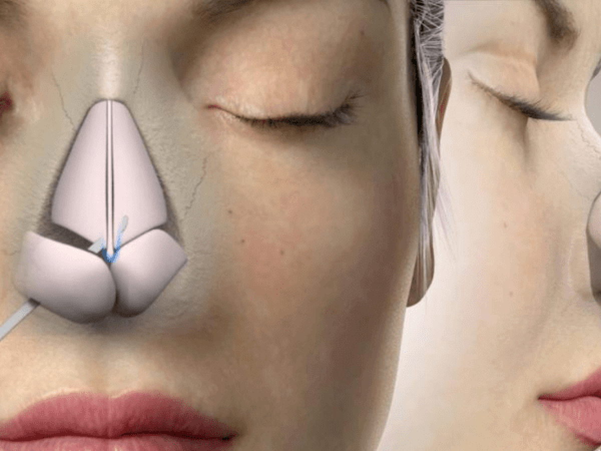 健康・医学 Closed rhinoplasty closed-rhinoplasty-or-open-