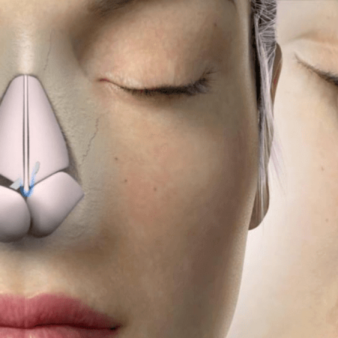 closed-rhinoplasty-or-open-