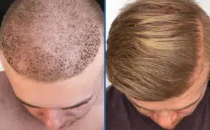 hair-transplant-method