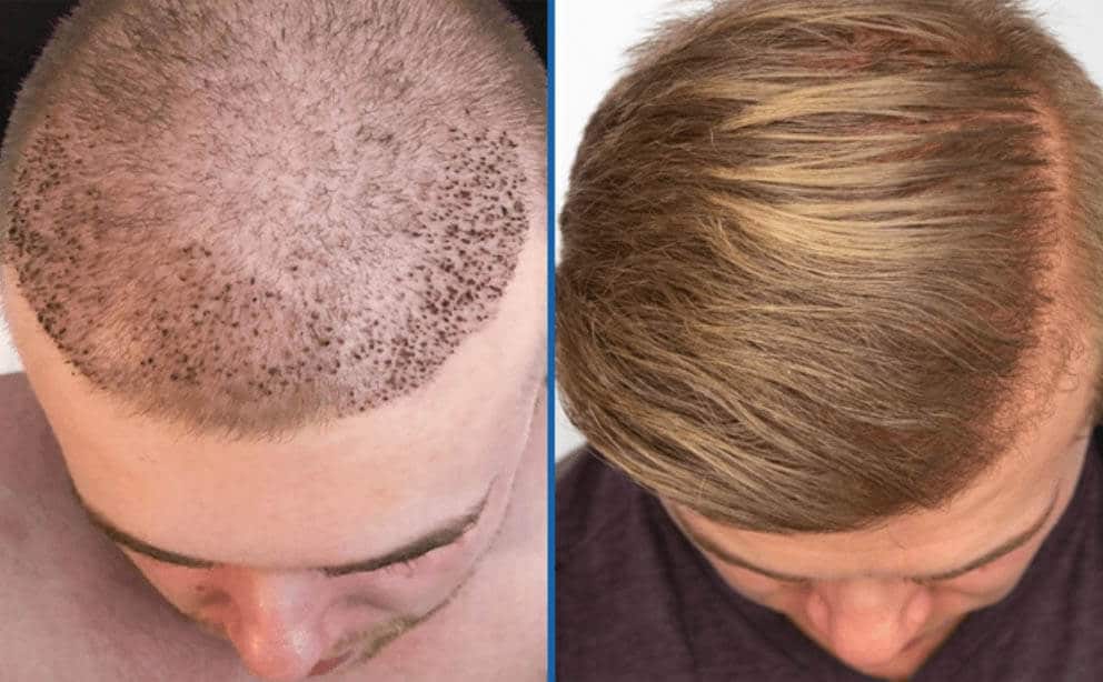 fue hair transplant near me