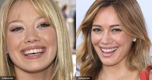 Celebrities with dental implants