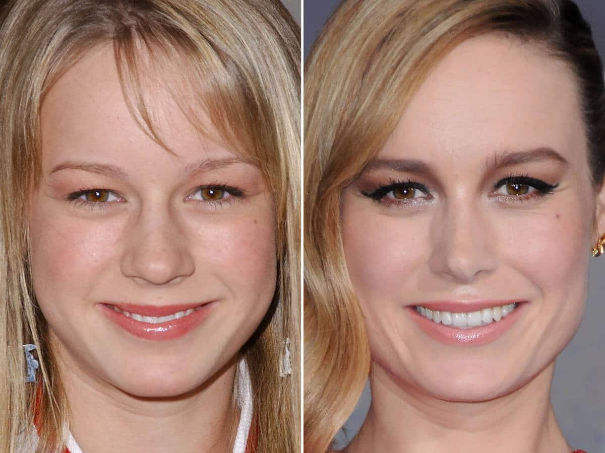 Celebs who have had nose jobs