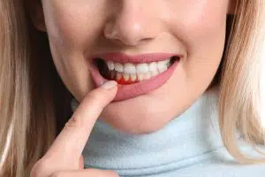 Bleeding Gums Causes And Solutions