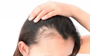 What is the Relationship Between Hormones and Hair Loss?