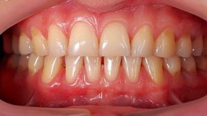 Aging Changes in Teeth and Gums