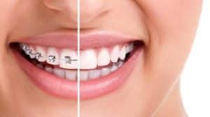 What is Teeth Straightening