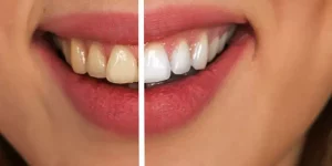 Dental White Teeth in Turkey
