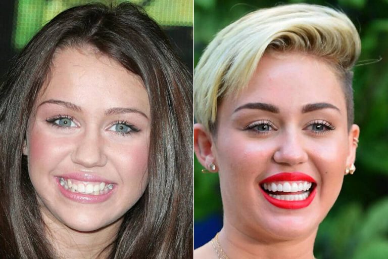 Celebrities With Veneers - Smile Team Turkey