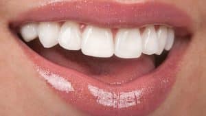 E-Max Veneers vs Laminate Veneers: Which One is Better? 