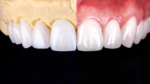 Everything About Composite Veneers 