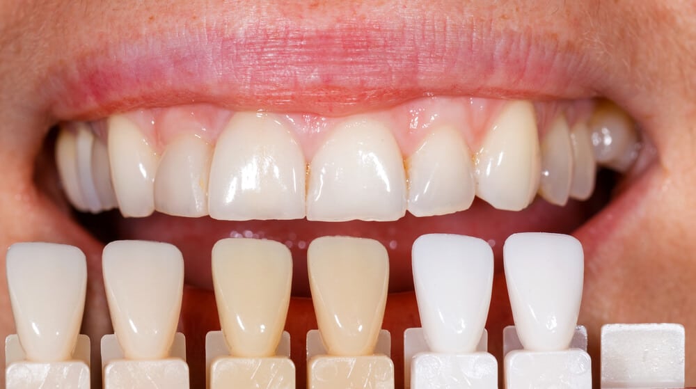 Everything About Composite Veneers