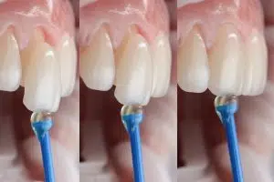 Is Veneer Teeth Shaving Necessary?