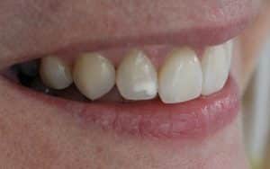 White Spots: What They Are and How To Get Rid Of Them - Center for  Restorative & Cosmetic Dentistry