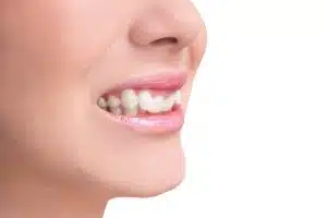 Causes and Treatments of Overbite