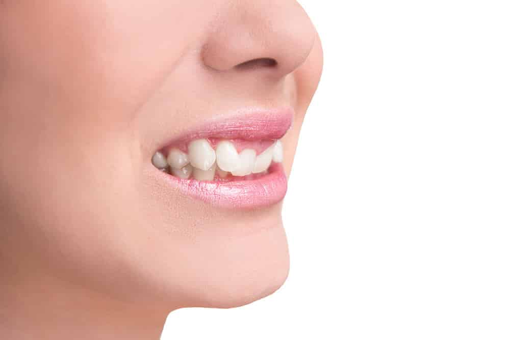 Causes And Treatments Of Overbite Smile Team Turkey