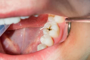 Cavities: What are They and How to Treat Them? 