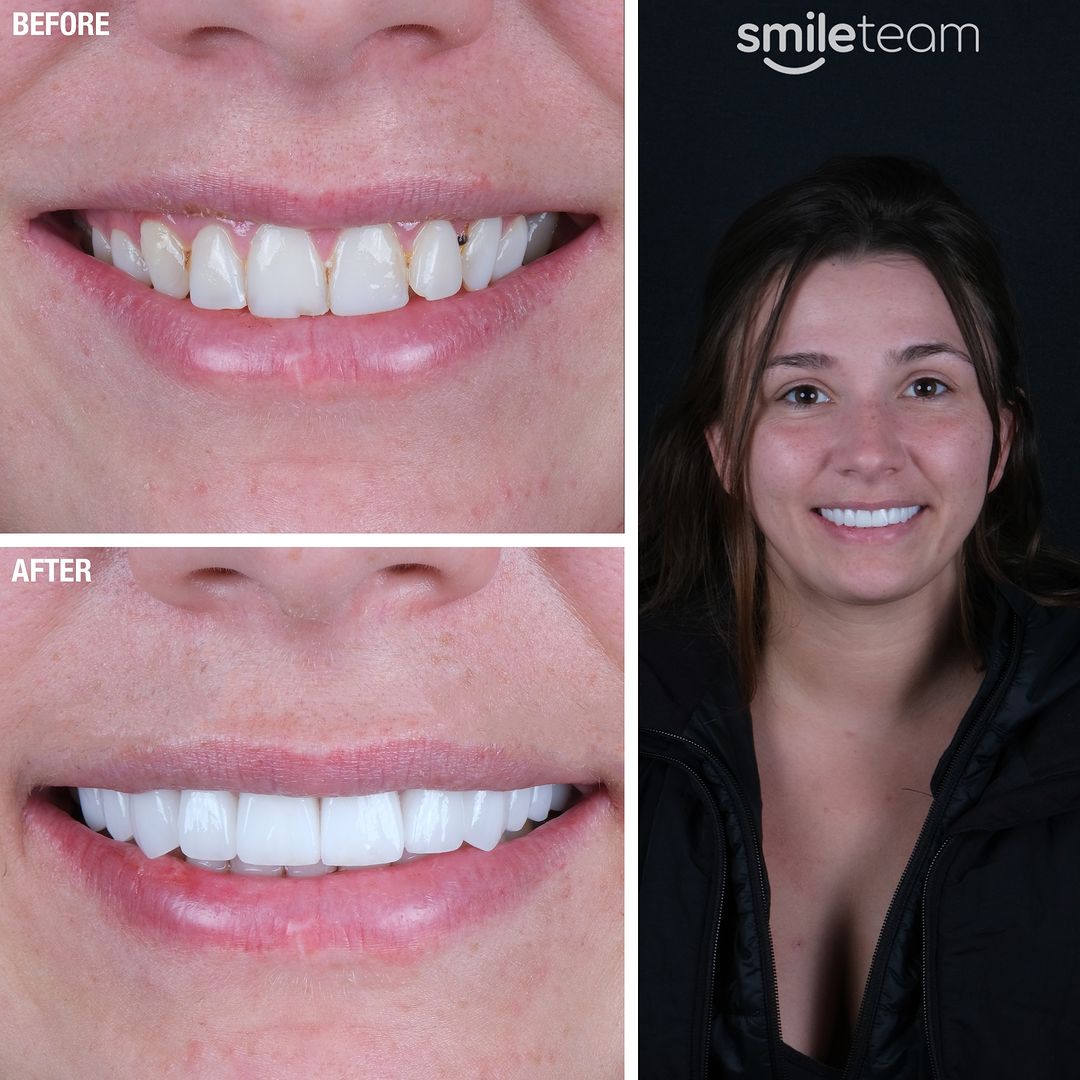 Before And After Dental Treatments Photos Smile Team Turkey