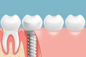 Dental Implants vs. Dentures: What's Right for You?