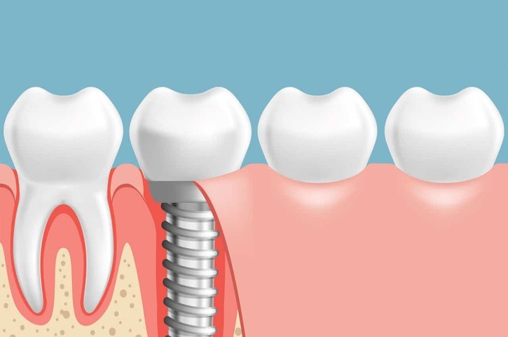 Dental Implants vs. Dentures: What's Right for You?