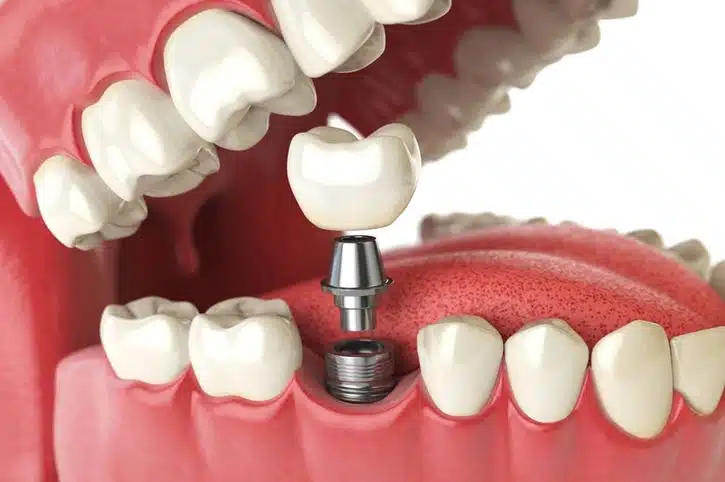 The Pros and Cons of Dental Implants vs. Crowns